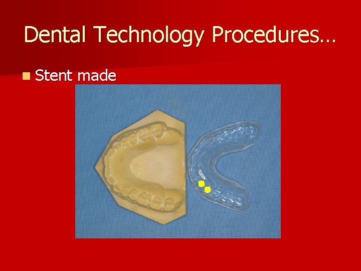 Dental Technology Procedures… n Stent made 