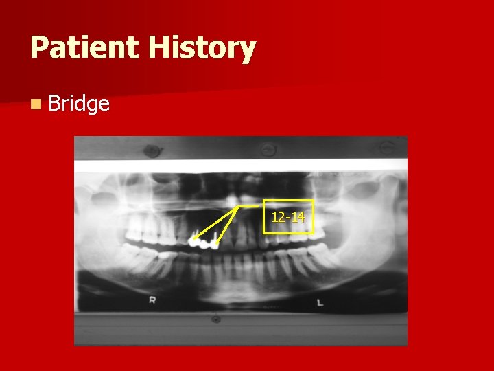 Patient History n Bridge 12 -14 