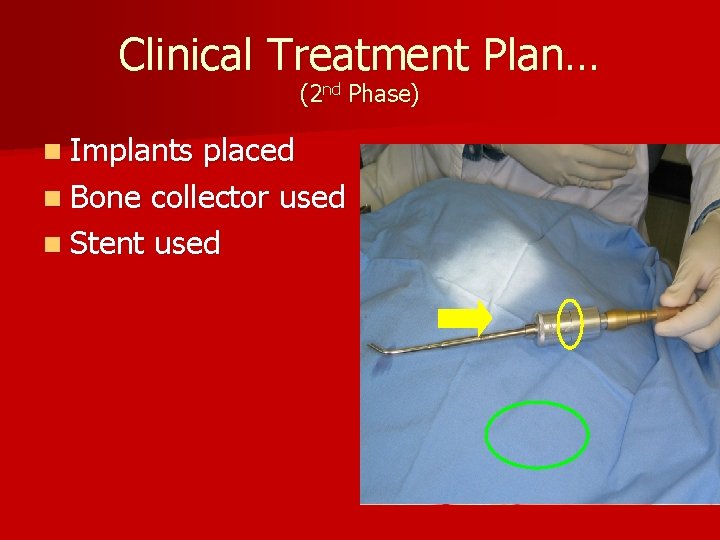 Clinical Treatment Plan… (2 nd Phase) n Implants placed n Bone collector used n