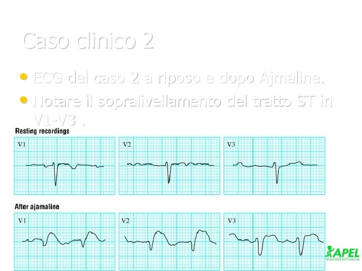 Caso clinico 2 • ECG del caso 2 a riposo e dopo Ajmaline. •