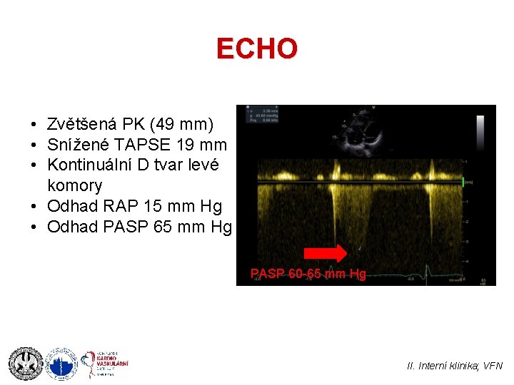 ECHO • Zvětšená PK (49 mm) • Snížené TAPSE 19 mm • Kontinuální D