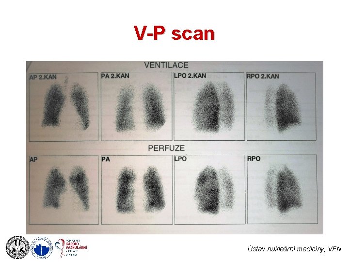 V-P scan Ústav nukleární medicíny; VFN 