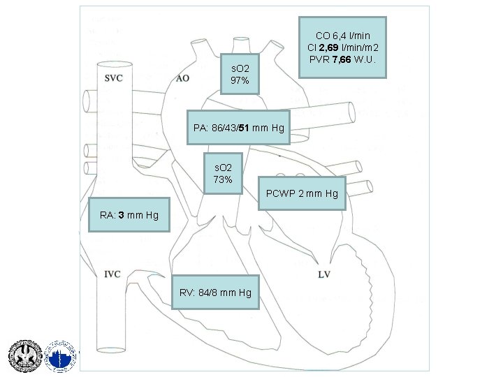 CO 6, 4 l/min CI 2, 69 l/min/m 2 PVR 7, 66 W. U.