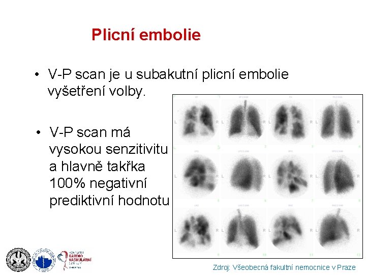 Plicní embolie • V-P scan je u subakutní plicní embolie vyšetření volby. • V-P