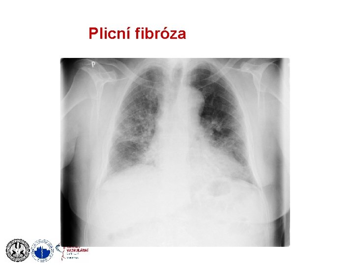 Plicní fibróza 