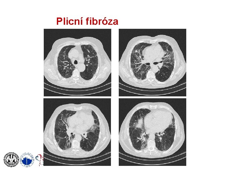 Plicní fibróza 