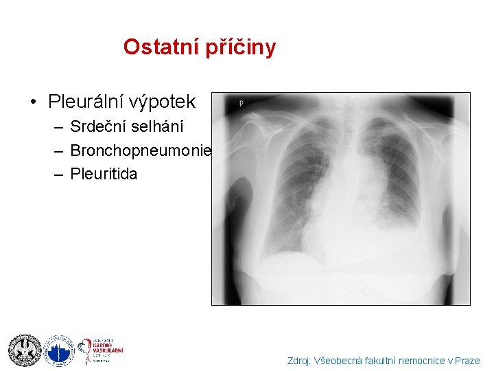 Ostatní příčiny • Pleurální výpotek – Srdeční selhání – Bronchopneumonie – Pleuritida Zdroj: Všeobecná