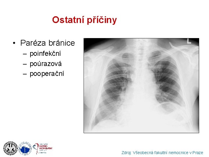 Ostatní příčiny • Paréza bránice – poinfekční – poúrazová – pooperační Zdroj: Všeobecná fakultní