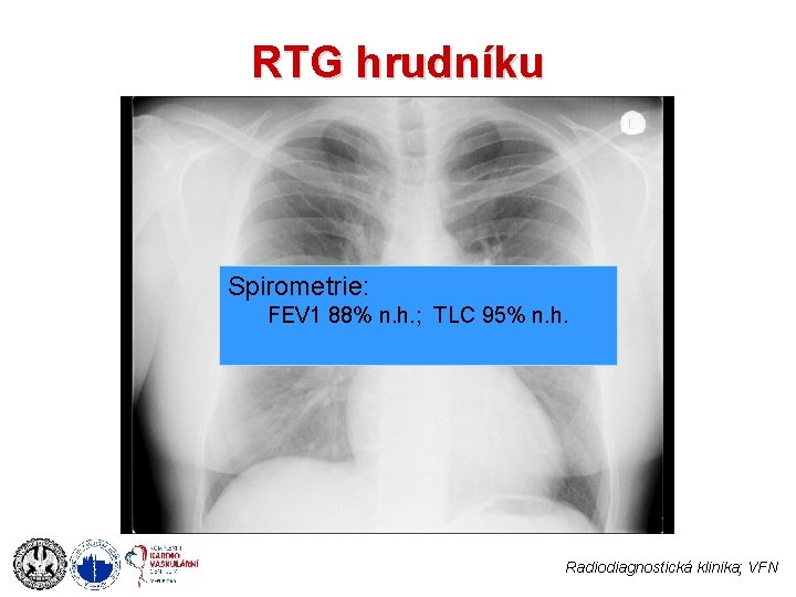 RTG hrudníku Spirometrie: FEV 1 88% n. h. ; TLC 95% n. h. Radiodiagnostická