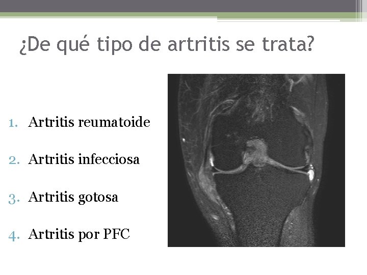 ¿De qué tipo de artritis se trata? 1. Artritis reumatoide 2. Artritis infecciosa 3.
