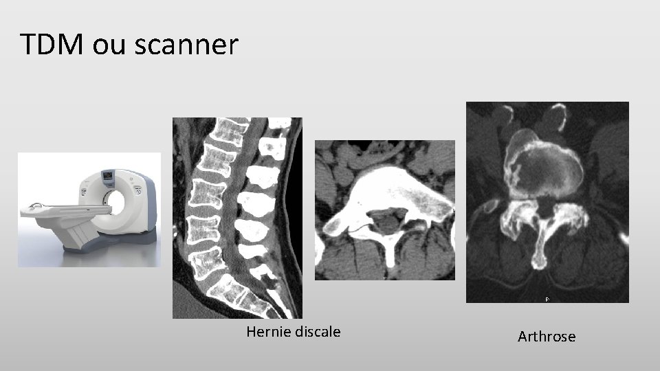 TDM ou scanner Hernie discale Arthrose 