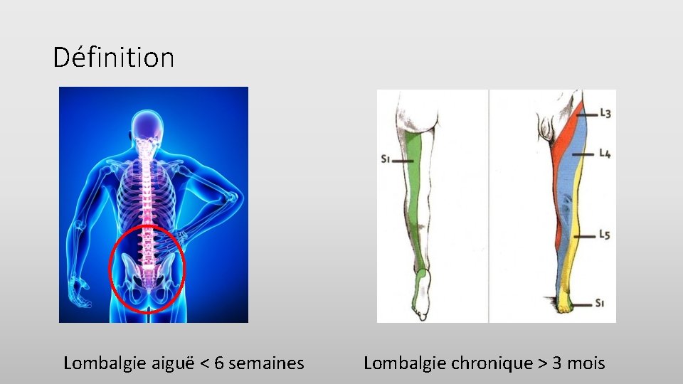 Définition Lombalgie aiguë < 6 semaines Lombalgie chronique > 3 mois 