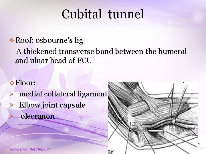 Cubital tunnel v Roof: osbourne’s lig A thickened transverse band between the humeral and