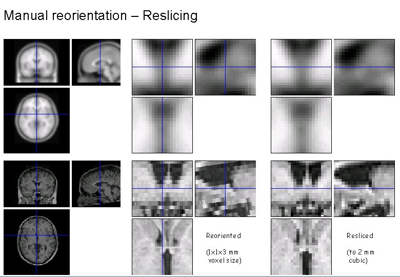 Manual reorientation – Reslicing Reoriented Resliced (1 x 1 x 3 mm voxel size)