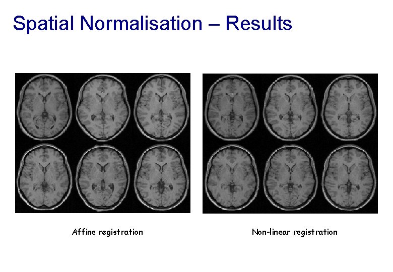 Spatial Normalisation – Results Affine registration Non-linear registration 
