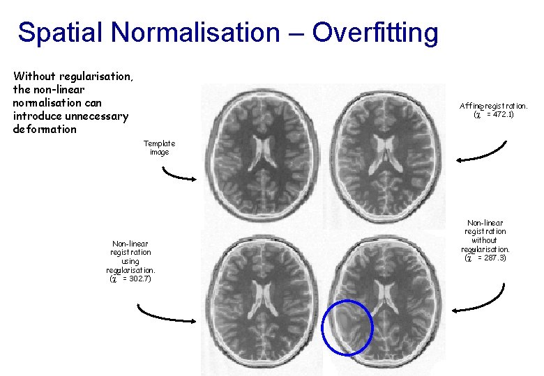Spatial Normalisation – Overfitting Without regularisation, the non-linear normalisation can introduce unnecessary deformation Affine