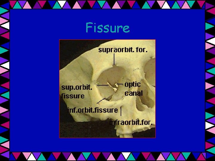 Fissure 