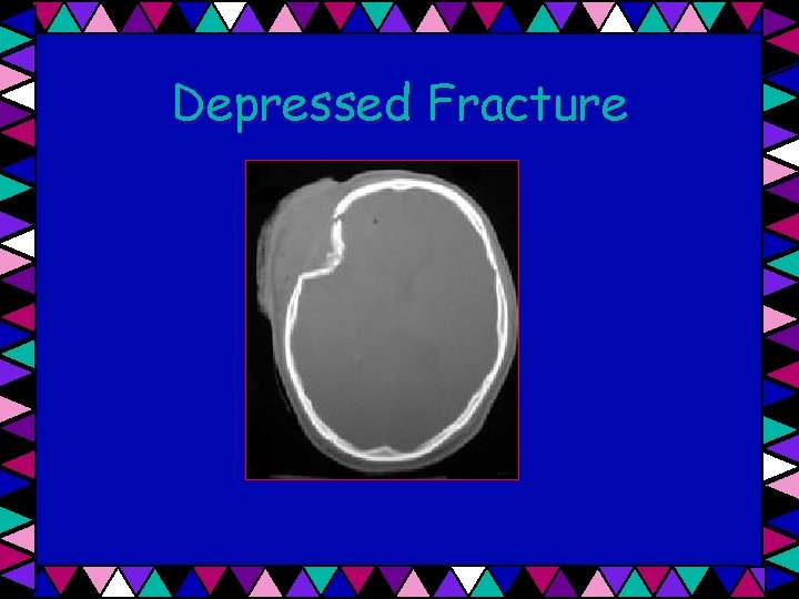 Depressed Fracture 