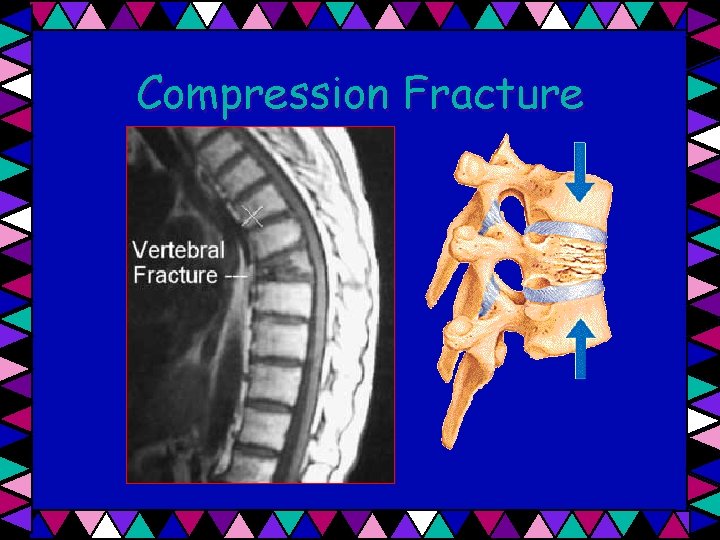 Compression Fracture 
