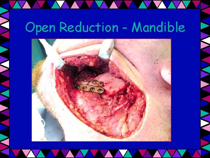 Open Reduction - Mandible 