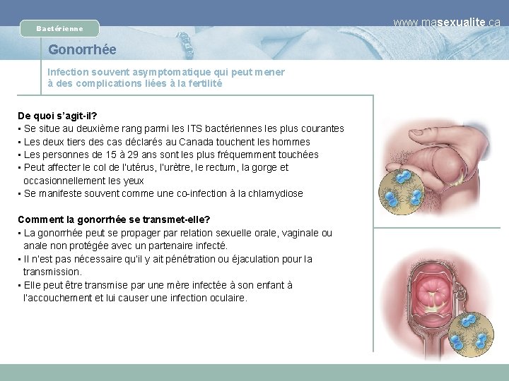 Bactérienne Gonorrhée Infection souvent asymptomatique qui peut mener à des complications liées à la