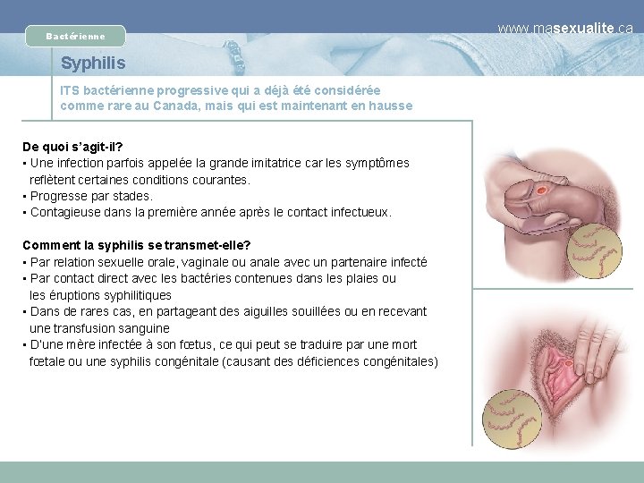 Bactérienne Syphilis ITS bactérienne progressive qui a déjà été considérée comme rare au Canada,