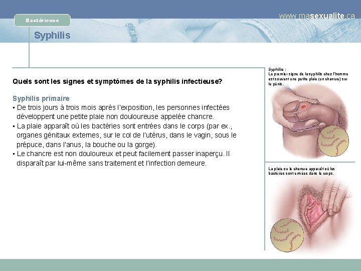 Bactérienne www. masexualite. ca Syphilis Quels sont les signes et symptômes de la syphilis