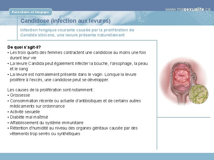 Parasitaire et fongique Candidose (infection aux levures) Infection fongique courante causée par la prolifération