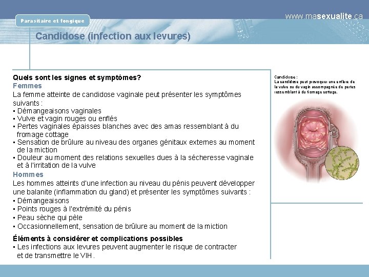 Parasitaire et fongique www. masexualite. ca Candidose (infection aux levures) Quels sont les signes