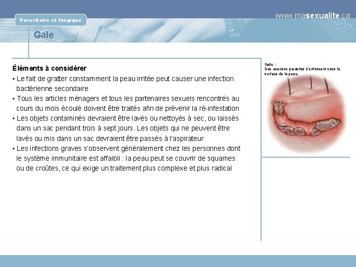 Parasitaire et fongique www. masexualite. ca Gale Éléments à considérer • Le fait de