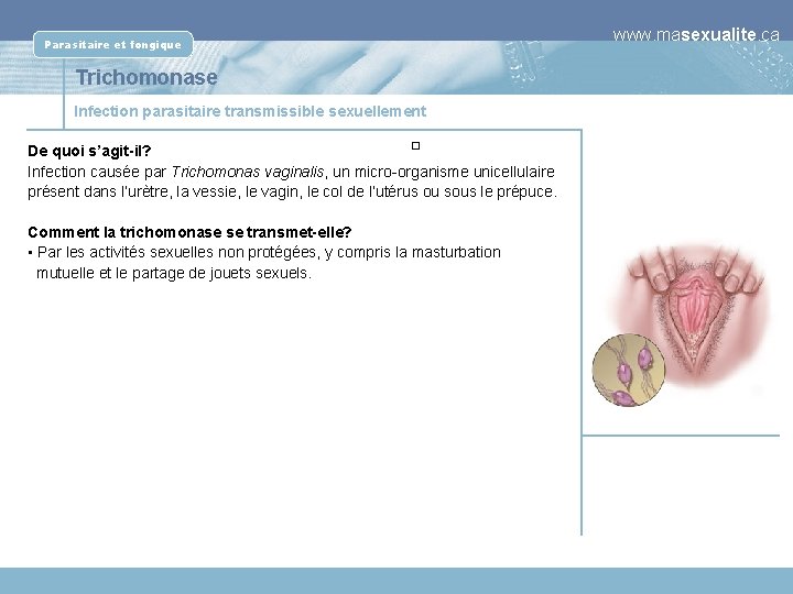 Parasitaire et fongique Trichomonase Infection parasitaire transmissible sexuellement � De quoi s’agit-il? Infection causée