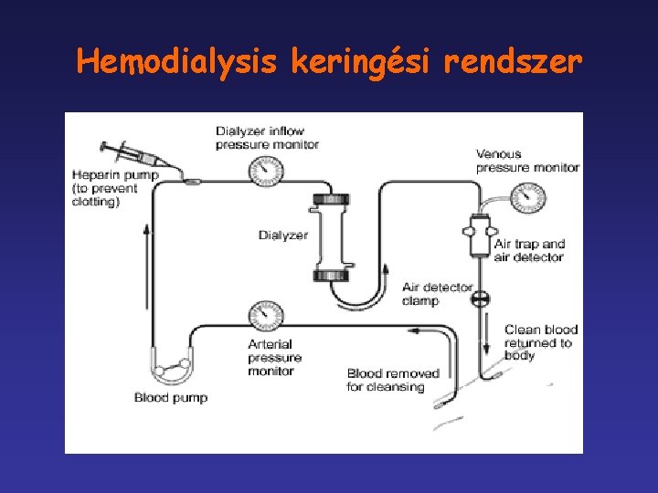 Hemodialysis keringési rendszer 