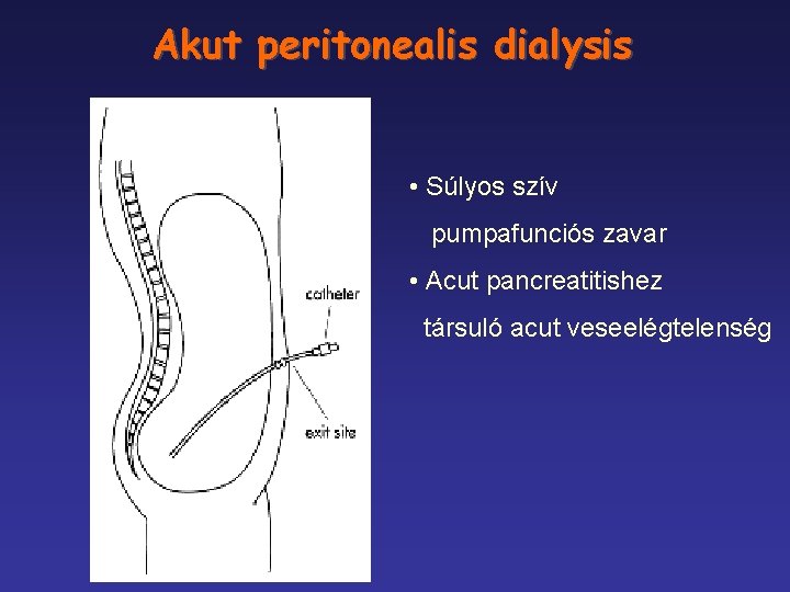 Akut peritonealis dialysis • Súlyos szív pumpafunciós zavar • Acut pancreatitishez társuló acut veseelégtelenség