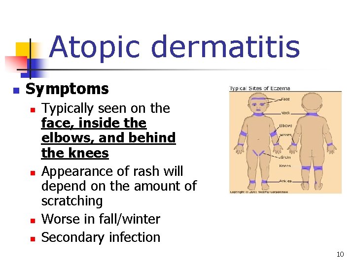 Atopic dermatitis n Symptoms n n Typically seen on the face, inside the elbows,