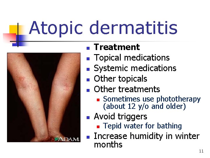 Atopic dermatitis n n n Treatment Topical medications Systemic medications Other topicals Other treatments