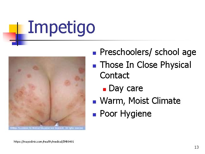Impetigo n n Preschoolers/ school age Those In Close Physical Contact n Day care