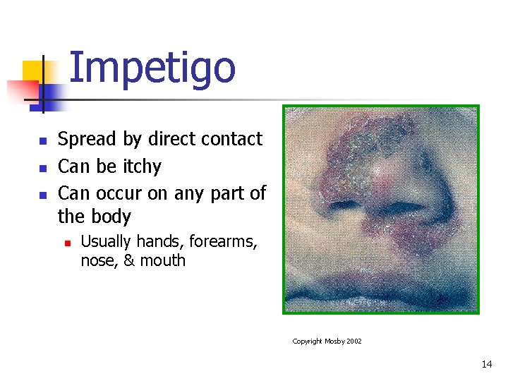 Impetigo n n n Spread by direct contact Can be itchy Can occur on