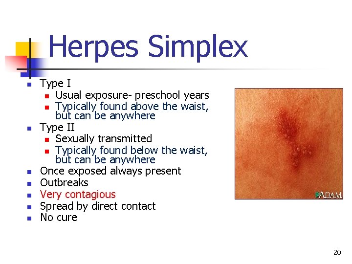 Herpes Simplex n n n n Type I n Usual exposure- preschool years n