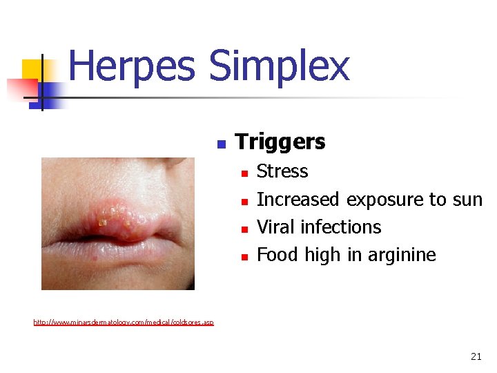 Herpes Simplex n Triggers n n Stress Increased exposure to sun Viral infections Food