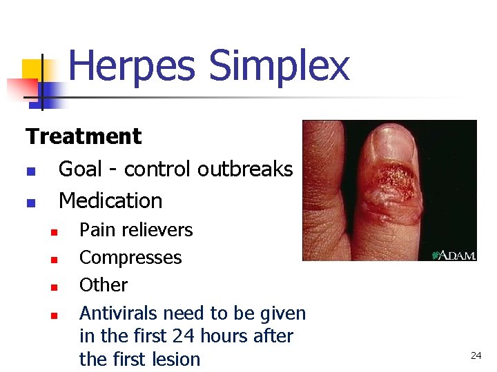 Herpes Simplex Treatment n Goal - control outbreaks n Medication n n Pain relievers
