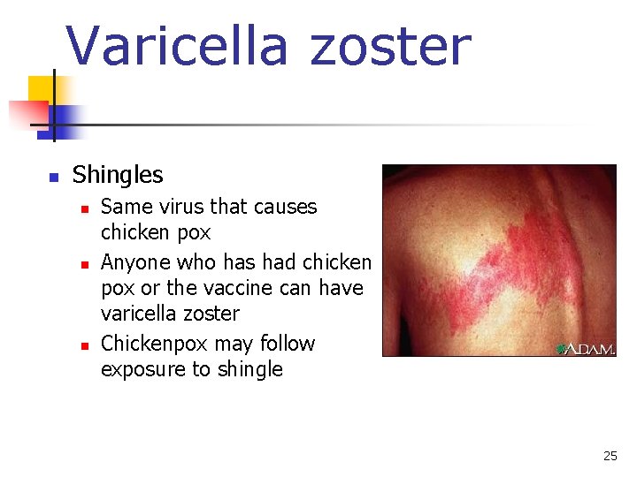 Varicella zoster n Shingles n n n Same virus that causes chicken pox Anyone