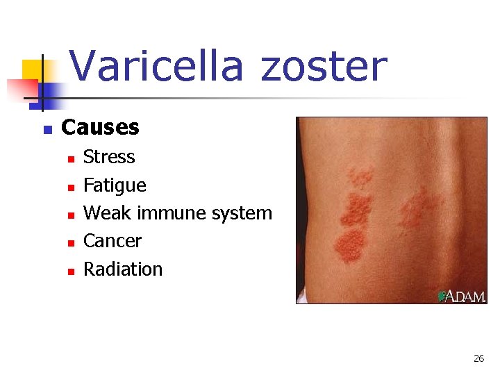 Varicella zoster n Causes n n n Stress Fatigue Weak immune system Cancer Radiation