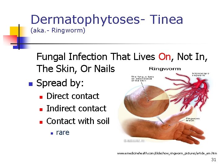 Dermatophytoses- Tinea (aka. - Ringworm) n Fungal Infection That Lives On, Not In, The