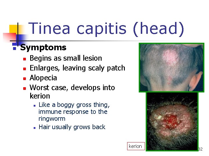 Tinea capitis (head) n Symptoms n n Begins as small lesion Enlarges, leaving scaly