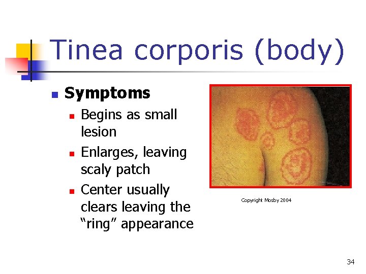 Tinea corporis (body) n Symptoms n n n Begins as small lesion Enlarges, leaving