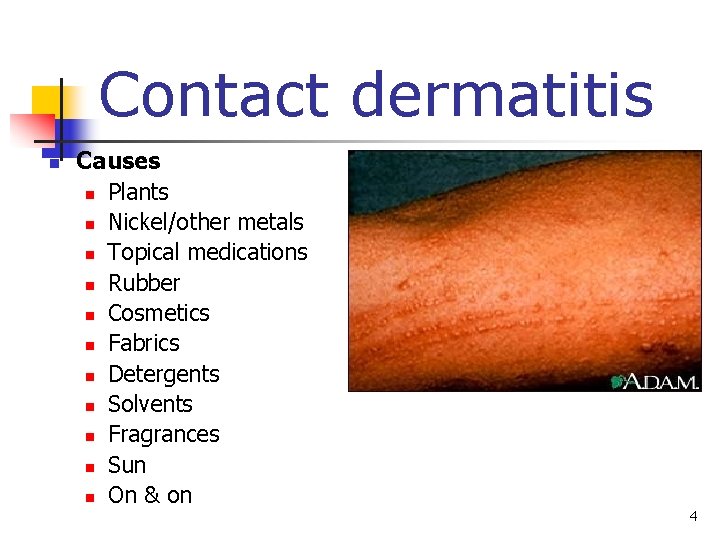 Contact dermatitis n Causes n Plants n Nickel/other metals n Topical medications n Rubber