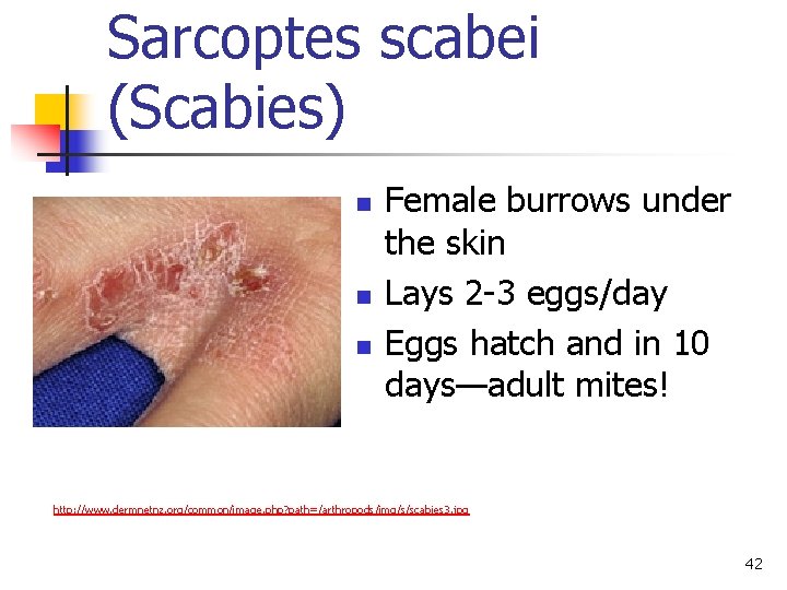 Sarcoptes scabei (Scabies) n n n Female burrows under the skin Lays 2 -3