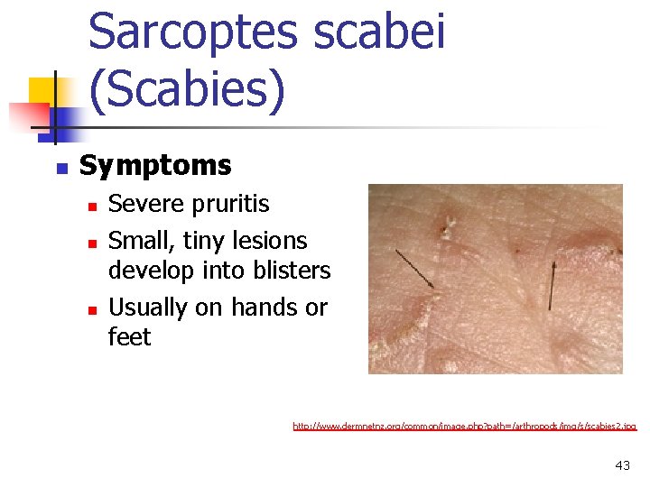 Sarcoptes scabei (Scabies) n Symptoms n n n Severe pruritis Small, tiny lesions develop