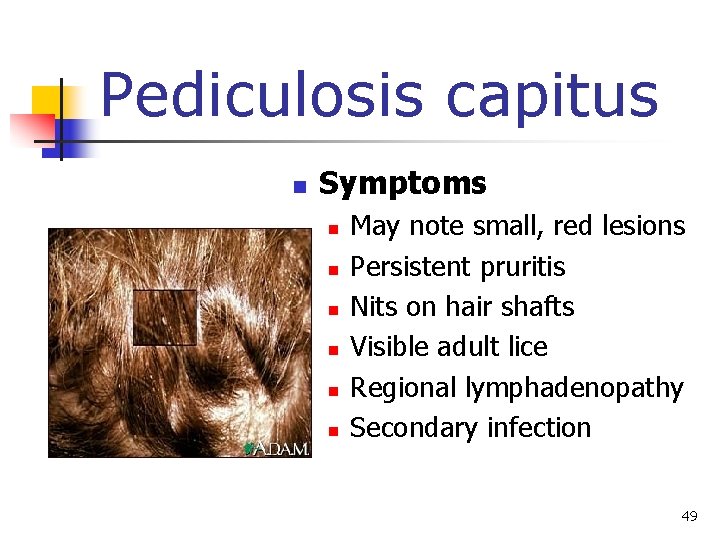 Pediculosis capitus n Symptoms n n n May note small, red lesions Persistent pruritis