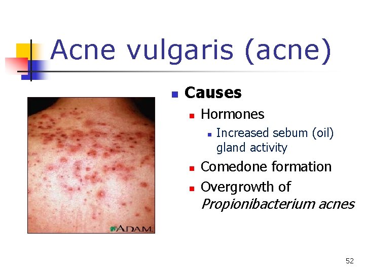 Acne vulgaris (acne) n Causes n Hormones n n n Increased sebum (oil) gland
